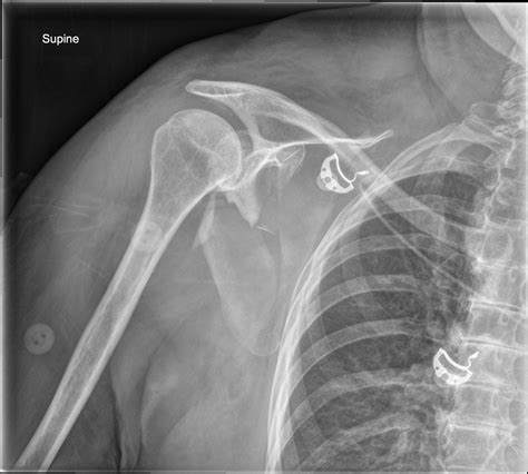 scapula tip fracture